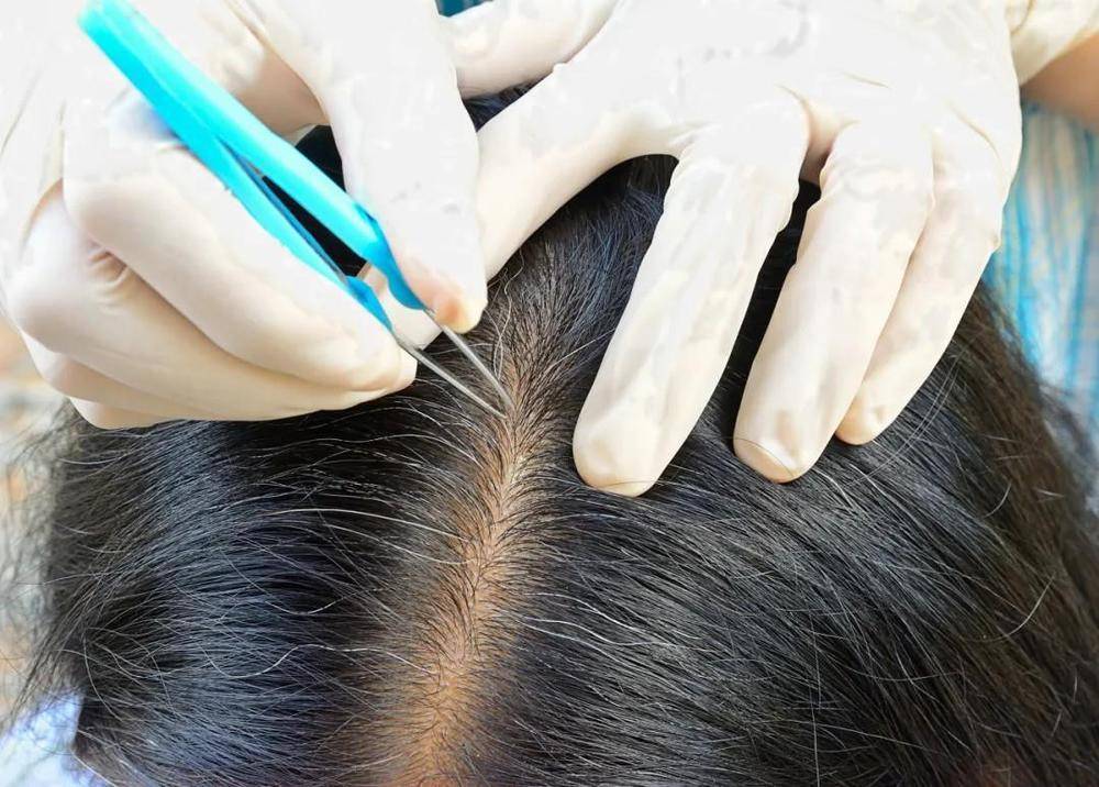 白头发拔一根长三根？到底能不能拔？终于弄清楚了