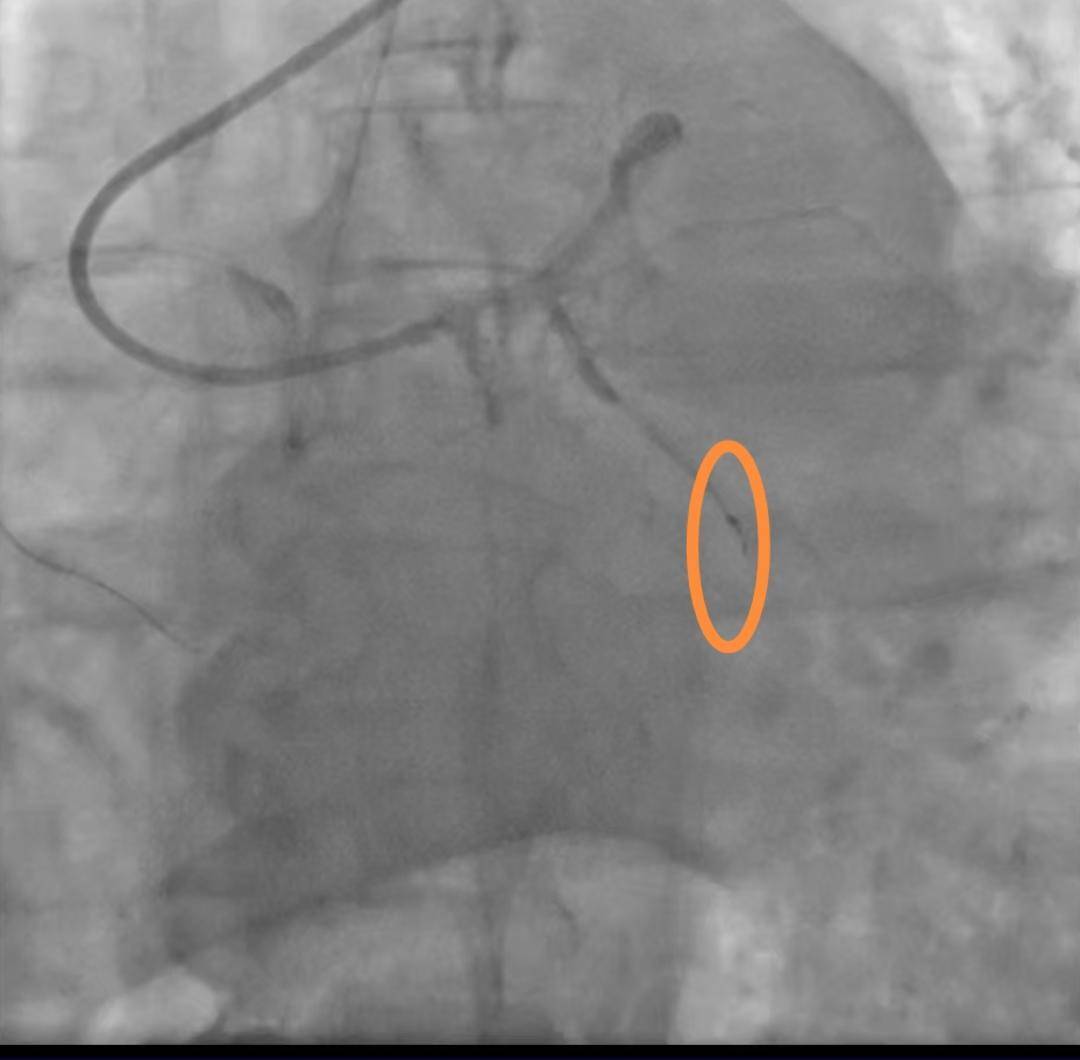 老人手术时导丝断裂掉进血管 医院：外科取出意义不大，补偿8000元