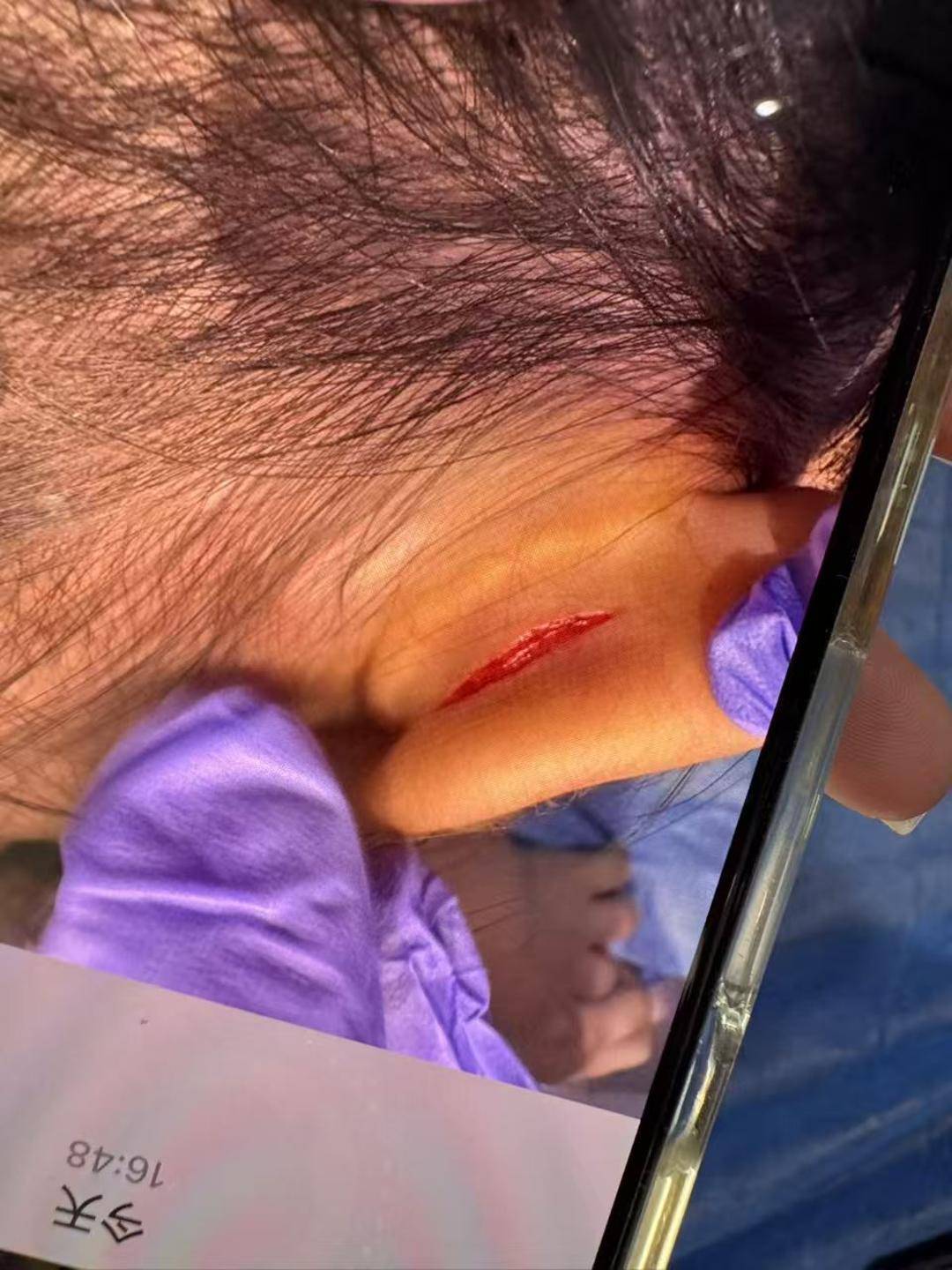 武汉一女童上高端托儿班耳朵疑被撕裂 家长：院方说监控坏了